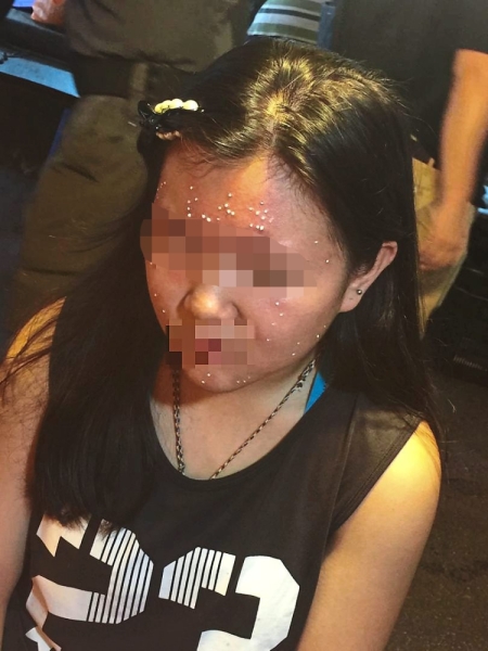 Photo of Jamie taken by her mother when she saw about 80 white spots from the mole removal cream despite them having earlier told the woman operating the night market stall to remove only six moles.