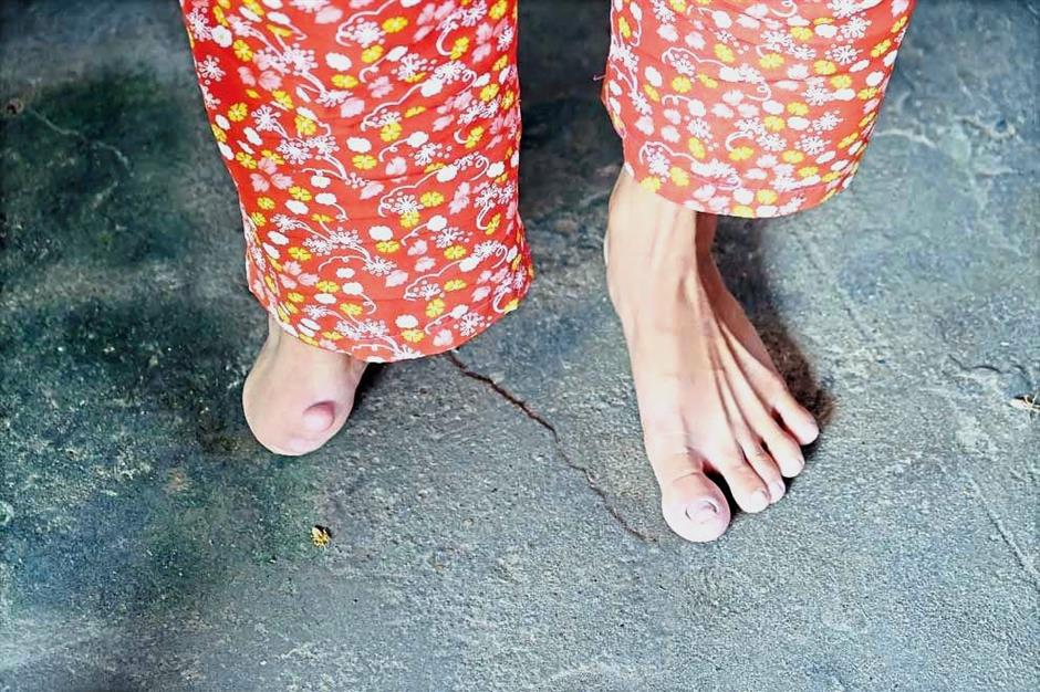 Born deformed: One of the villagers with an underdeveloped right foot. — Photos: The Phnom Penh Post
