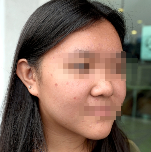 Three weeks after the procedure, Jamie is left with scars on her face, including spots where she never had moles.