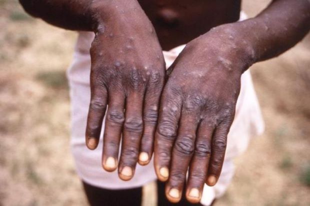 Risk of monkeypox spreading to Malaysia is low, says Health Ministry | The  Star
