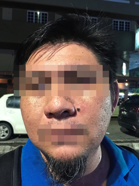 Photo taken right after the procedure. Chan felt as if his skin was burning.