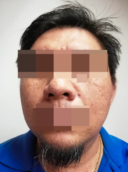A week after the mole removal procedure at the night market, Chan now has a hollow scar on his face.